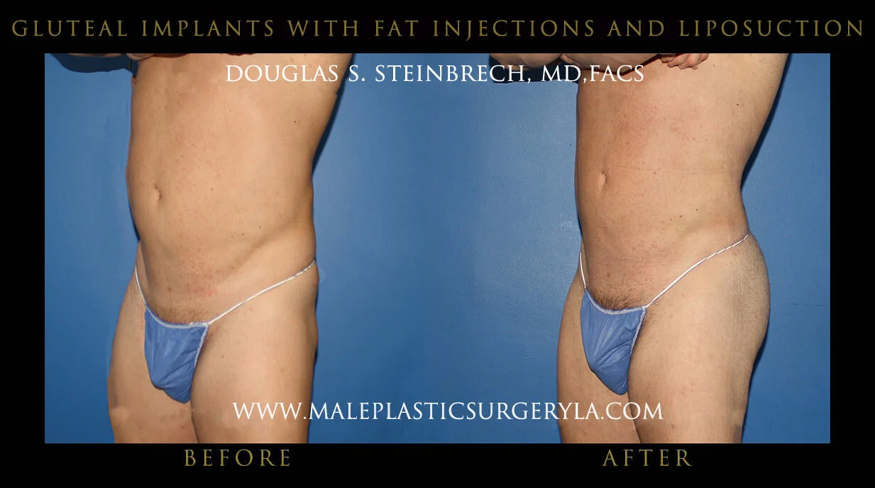 Gluteal Buttock Implants - Before & After Photos