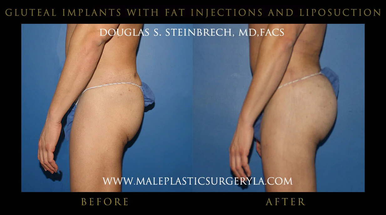 Gluteal Buttock Implants - Before & After Photos