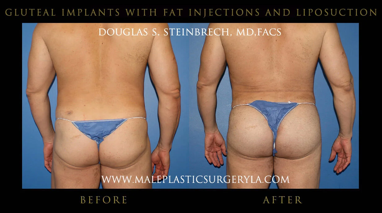 Gluteal Buttock Implants - Before & After Photos