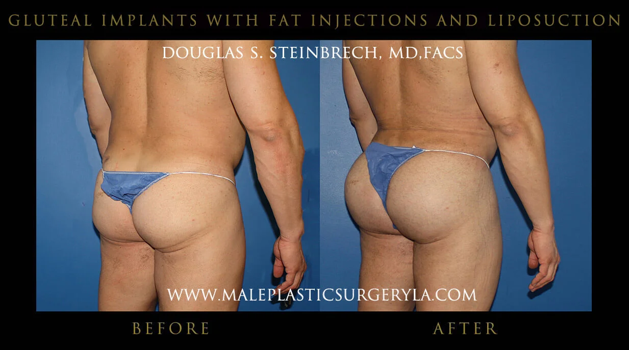 Gluteal Buttock Implants - Before & After Photos