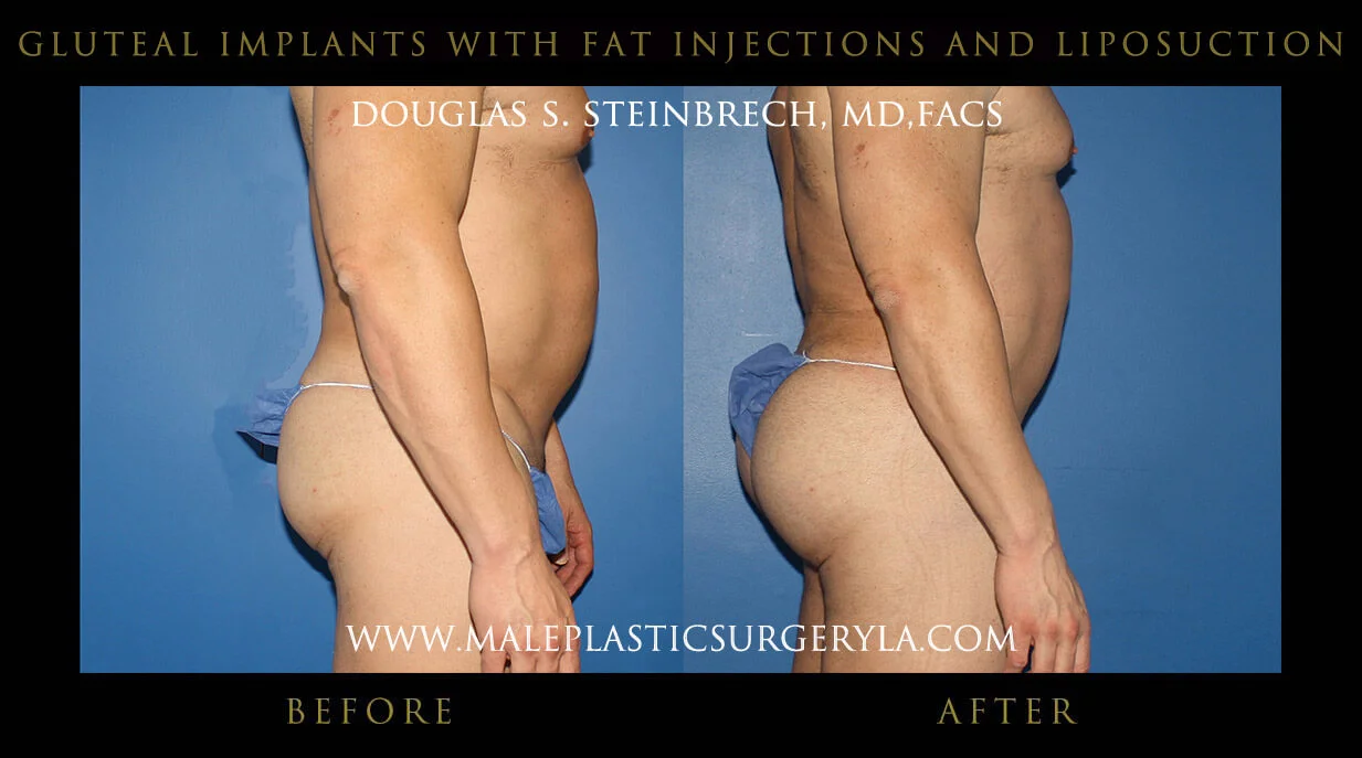 Gluteal Buttock Implants - Before & After Photos