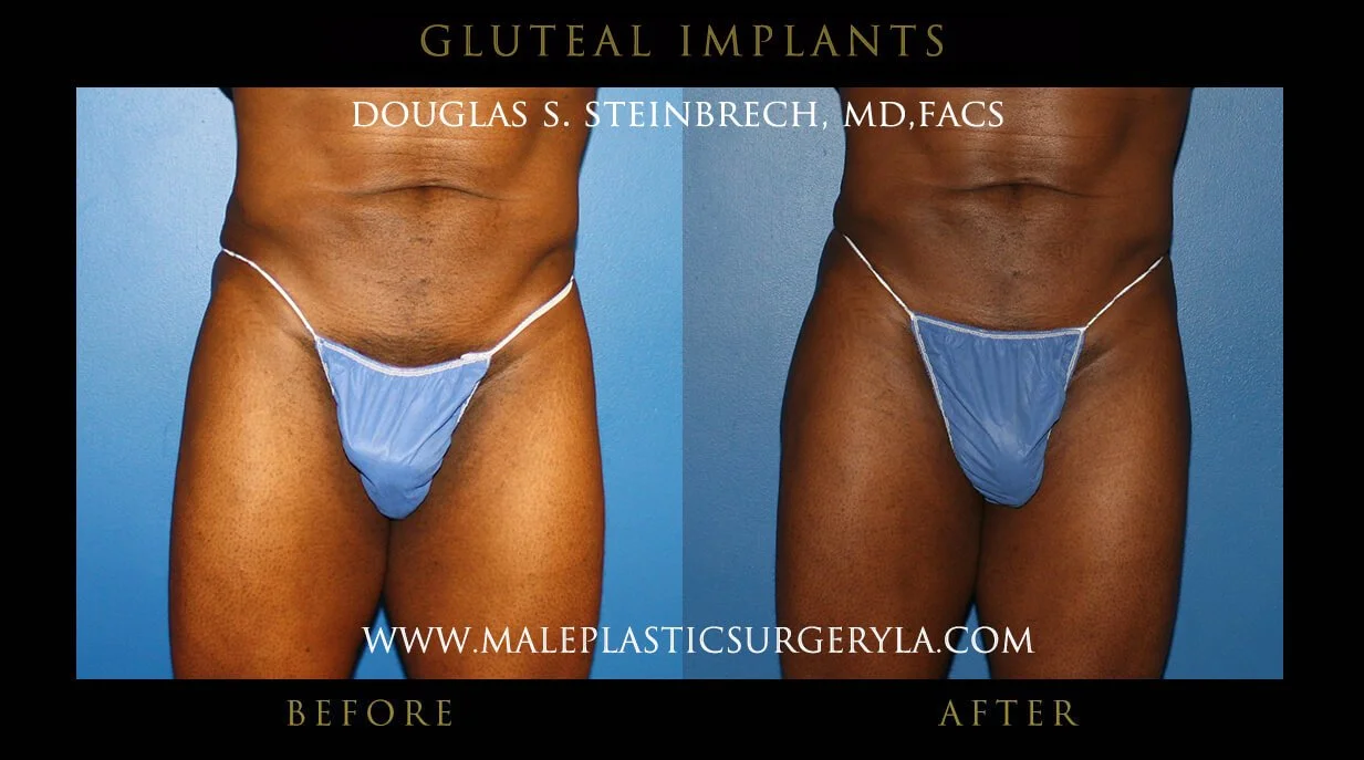 Gluteal Buttock Implants - Before & After Photos