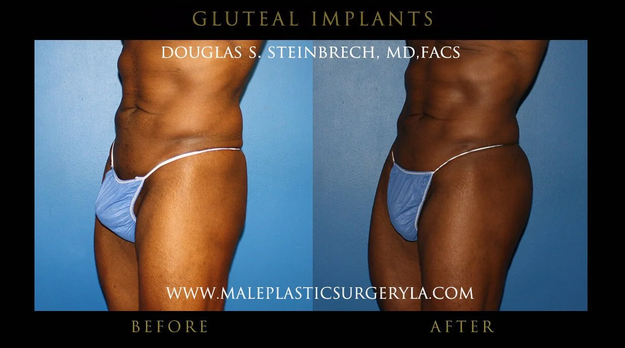 Gluteal Buttock Implants - Before & After Photos