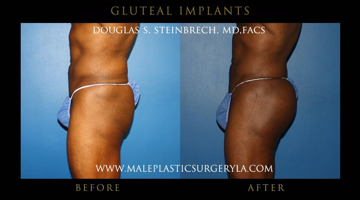 Gluteal Buttock Implants - Before & After Photos