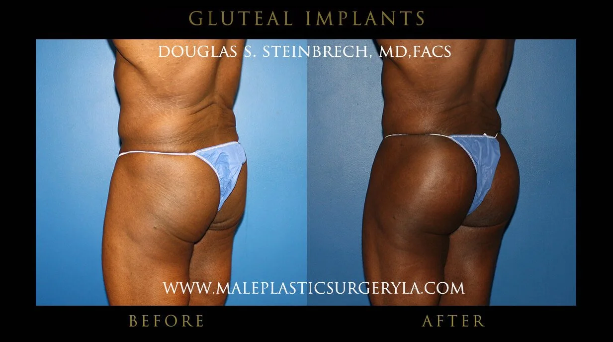 Gluteal Buttock Implants - Before & After Photos