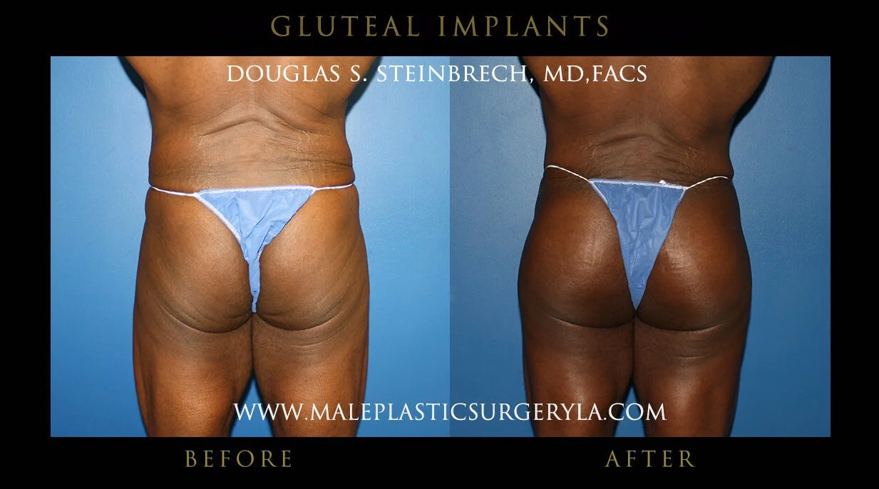 Gluteal Buttock Implants - Before & After Photos