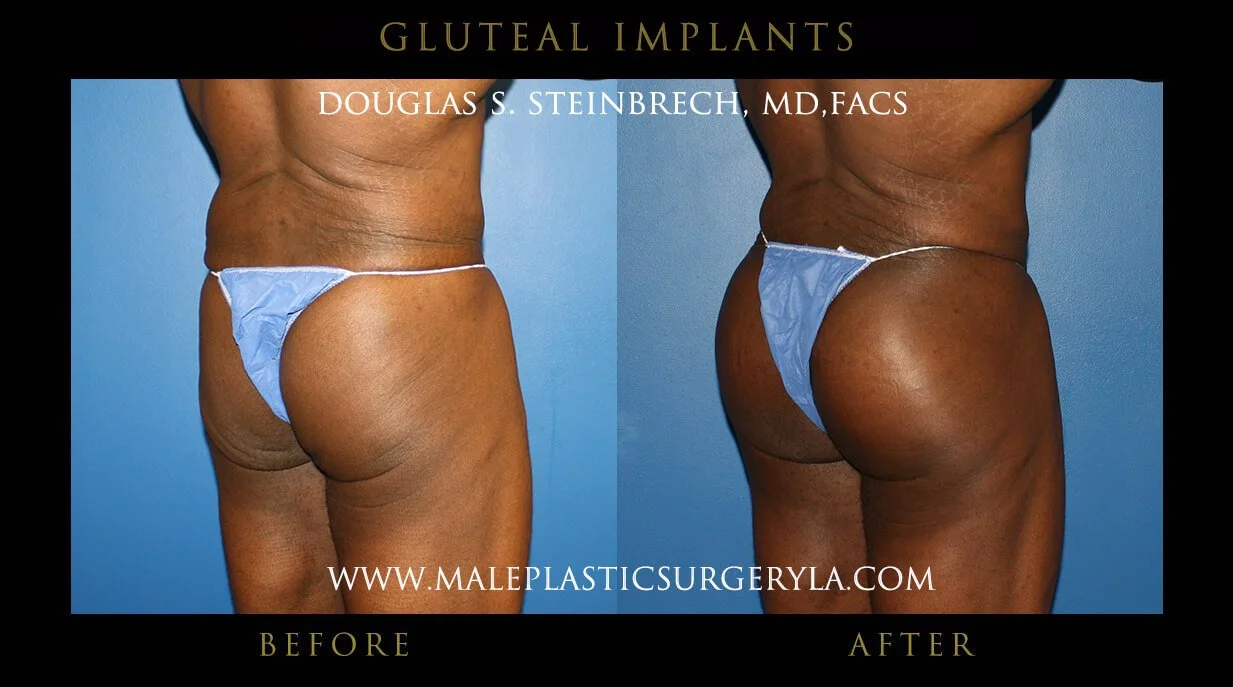 Gluteal Buttock Implants - Before & After Photos