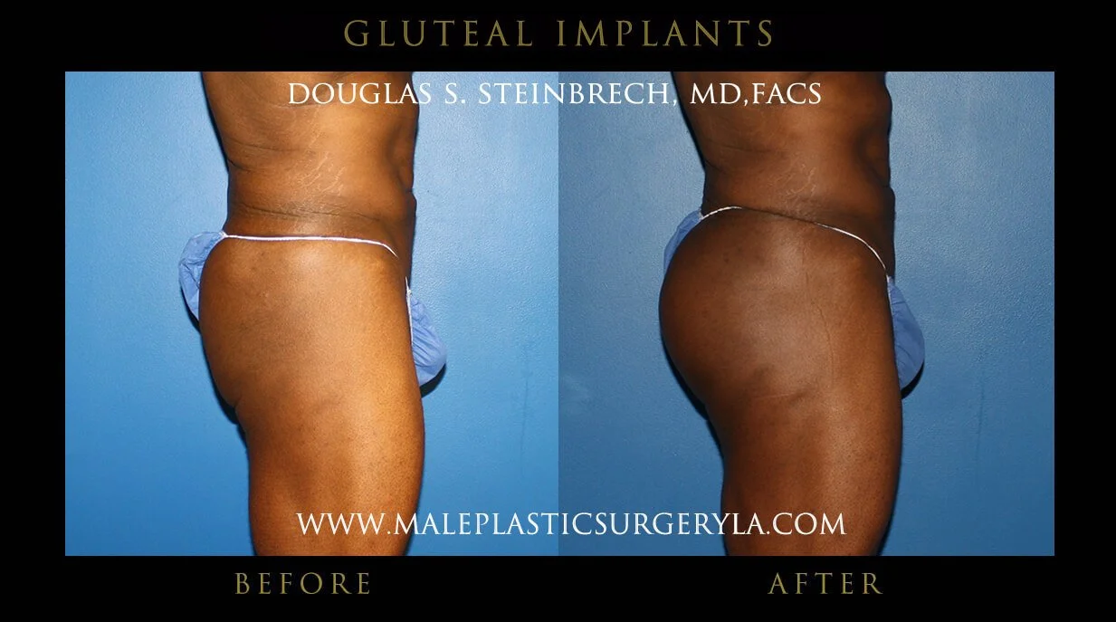 Gluteal Buttock Implants - Before & After Photos