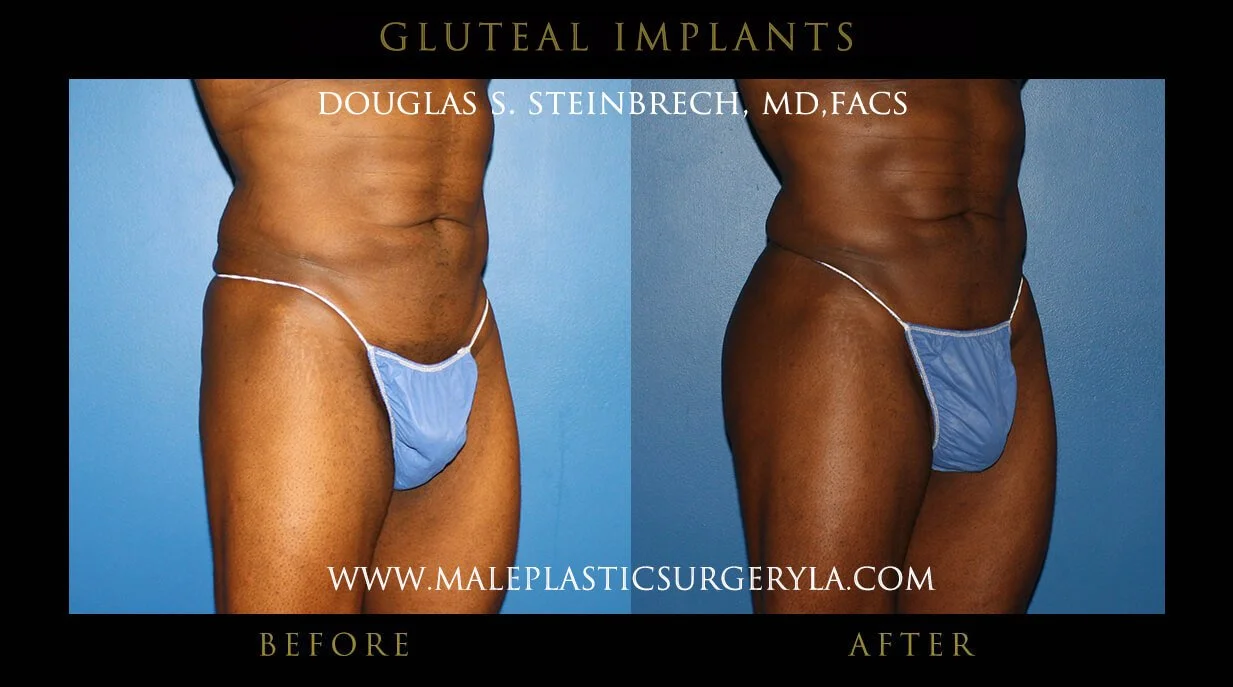 Gluteal Buttock Implants - Before & After Photos