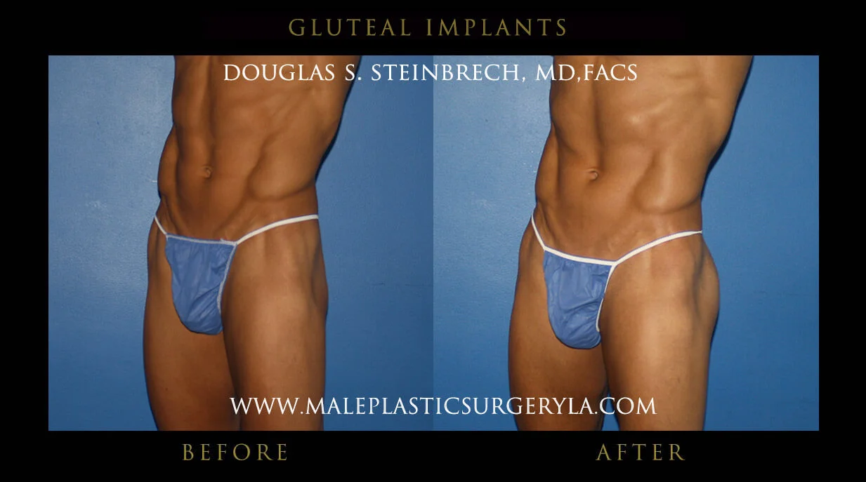 Gluteal Buttock Implants - Before & After Photos