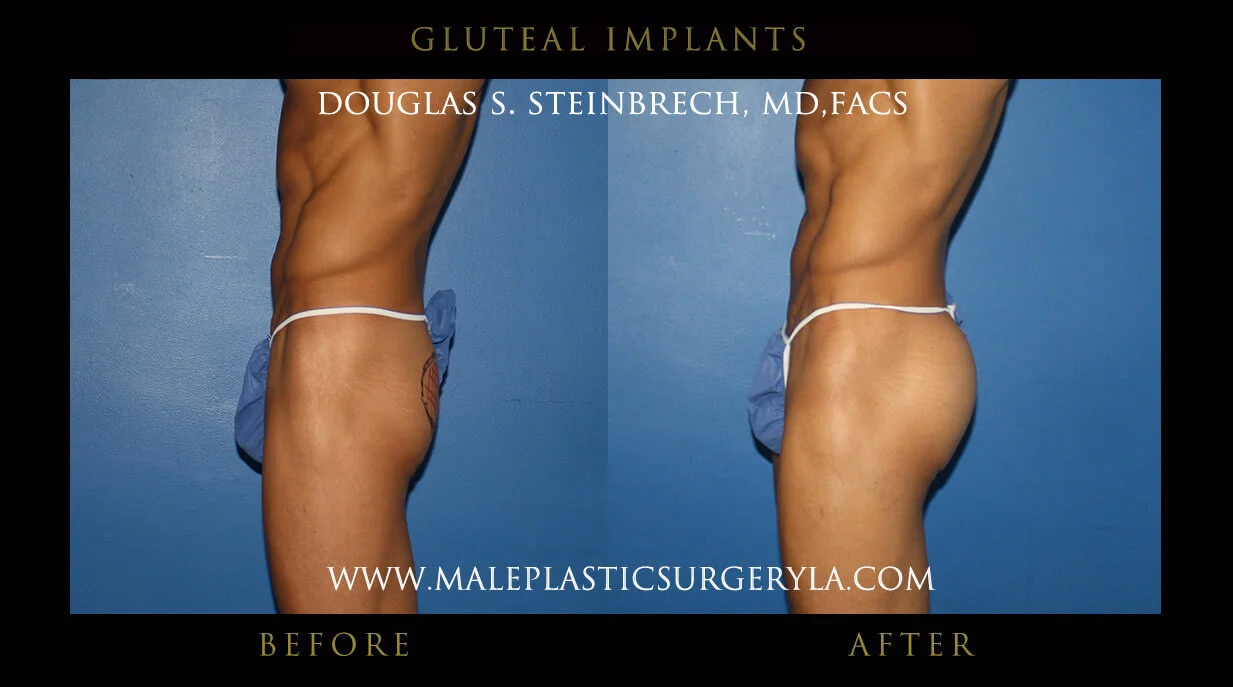 Gluteal Buttock Implants - Before & After Photos