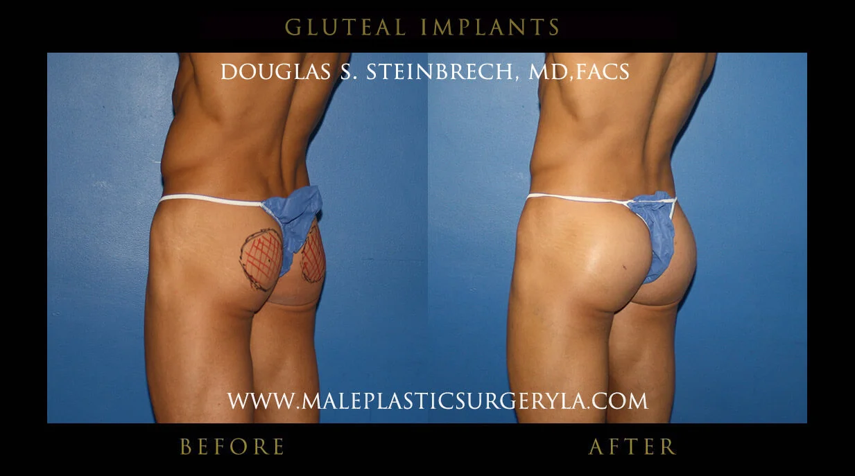 Gluteal Buttock Implants - Before & After Photos