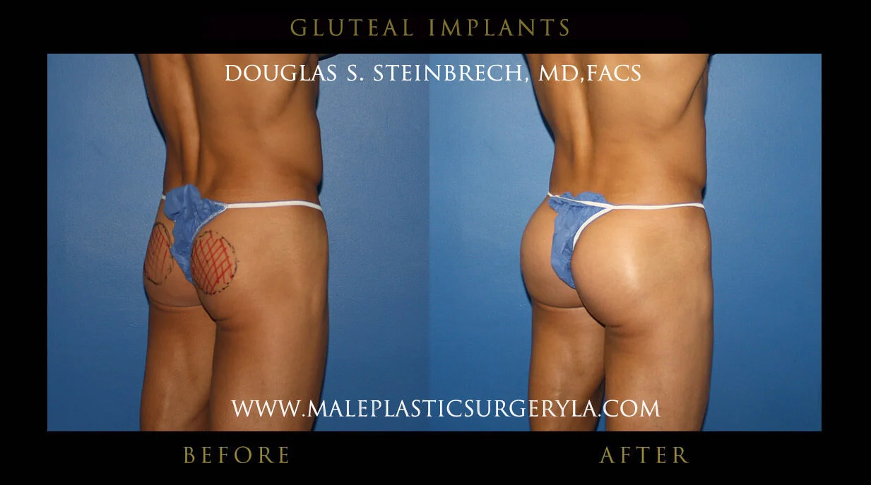 Gluteal Buttock Implants - Before & After Photos