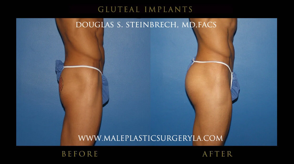 Gluteal Buttock Implants - Before & After Photos