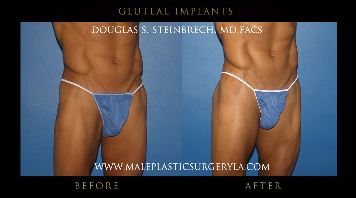 Gluteal Buttock Implants - Before & After Photos