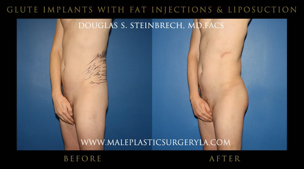 Gluteal Buttock Implants - Before & After Photos