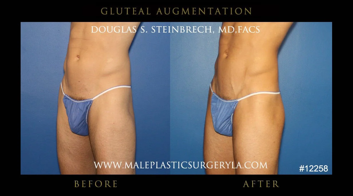 Gluteal Buttock Implants - Before & After Photos