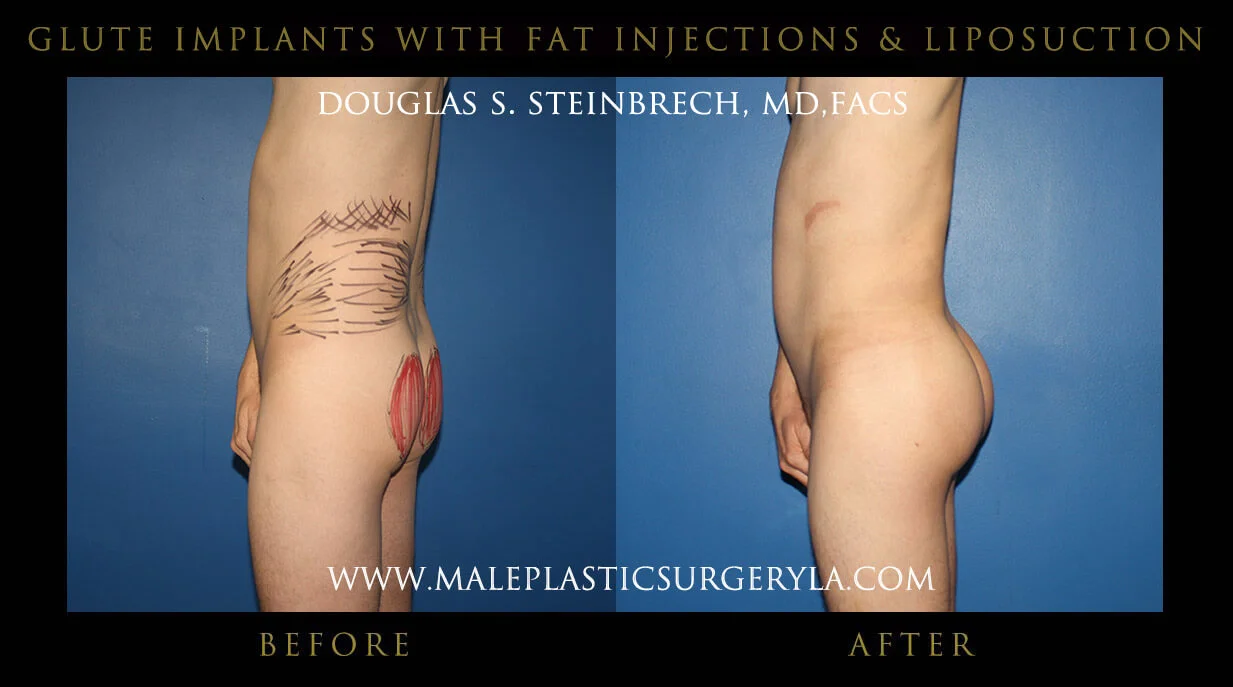 Gluteal Buttock Implants - Before & After Photos