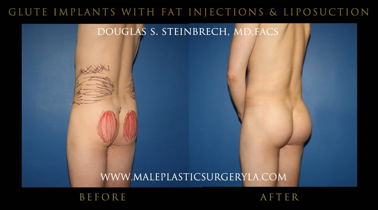 Gluteal Buttock Implants - Before & After Photos