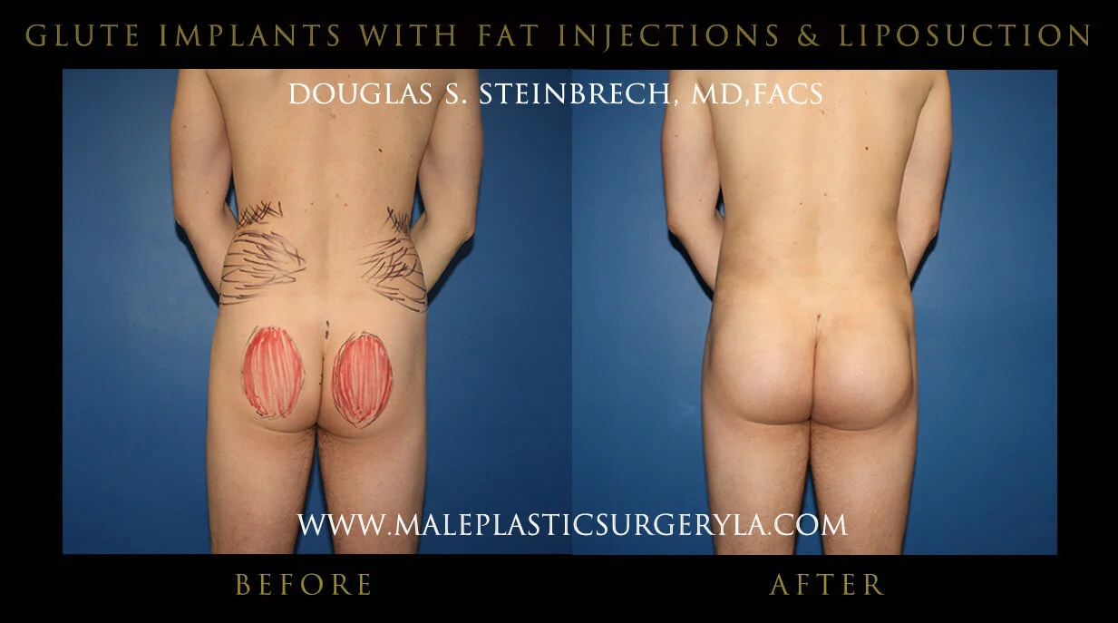 Gluteal Buttock Implants - Before & After Photos