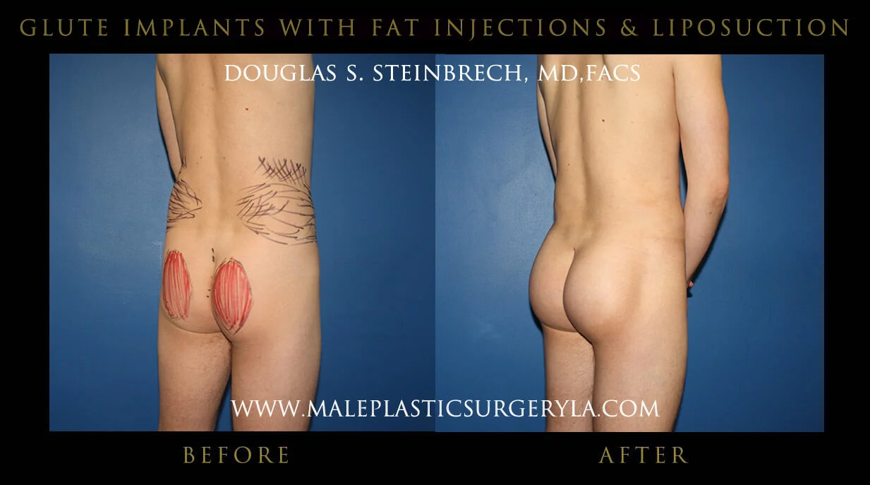 Gluteal Buttock Implants - Before & After Photos