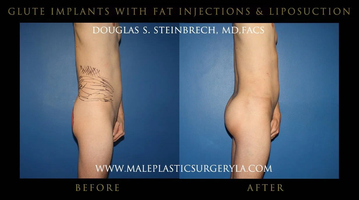 Gluteal Buttock Implants - Before & After Photos