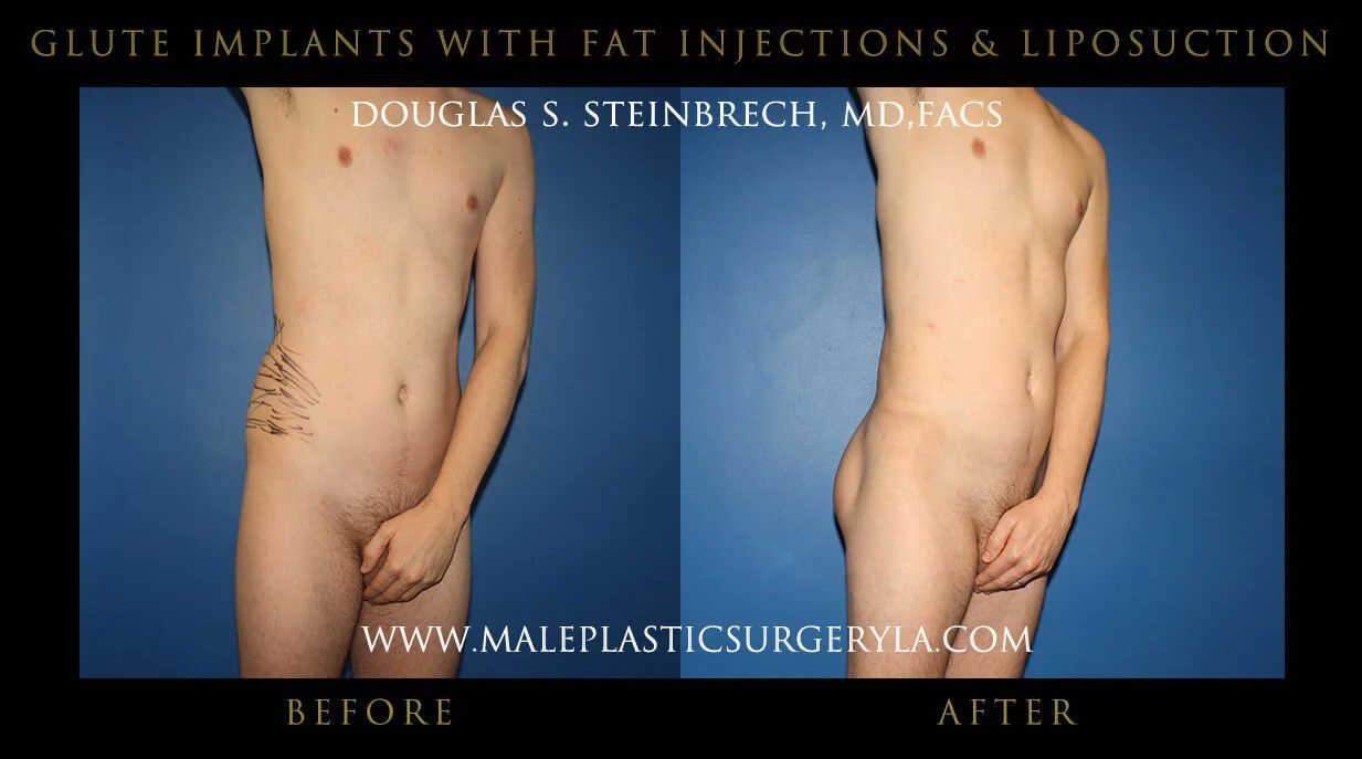 Gluteal Buttock Implants - Before & After Photos