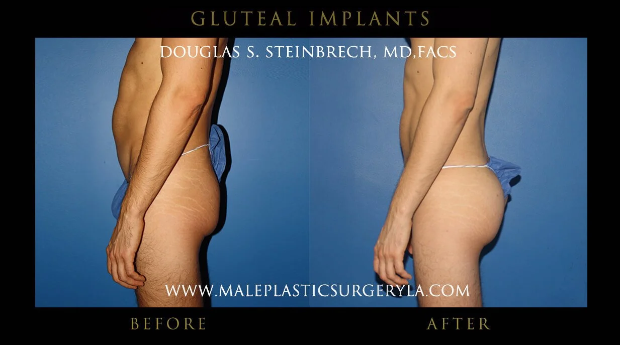 Gluteal Buttock Implants - Before & After Photos