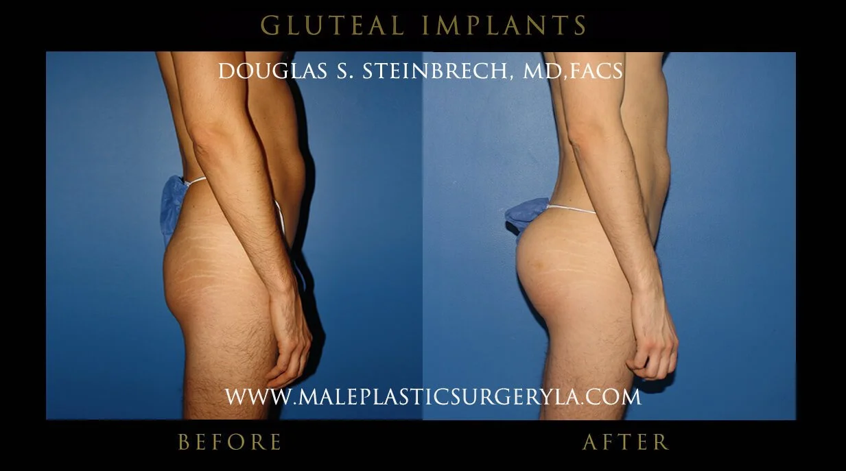 Gluteal Buttock Implants - Before & After Photos