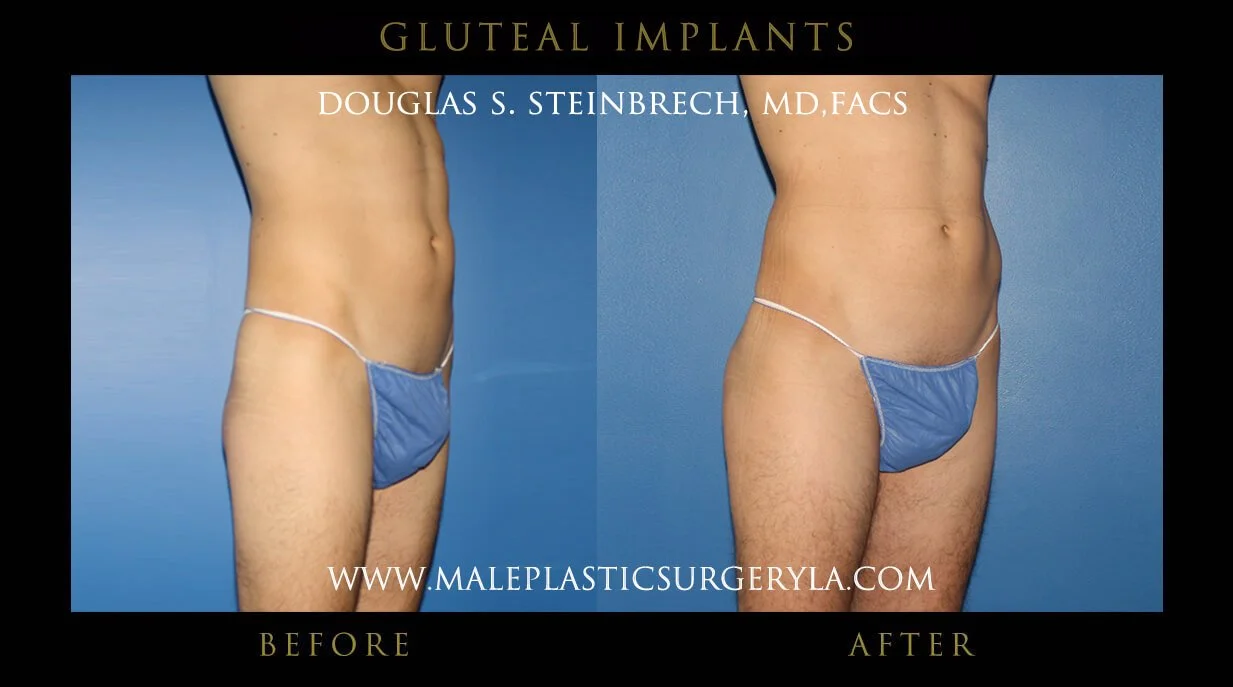 Gluteal Buttock Implants - Before & After Photos