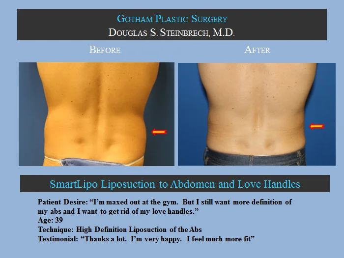 Liposuction - Before & After Photos