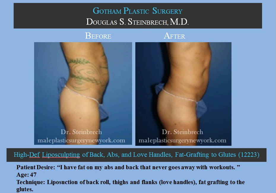 Liposuction - Before & After Photos