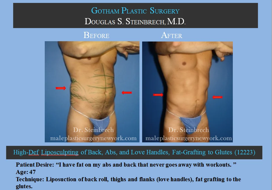 Liposuction - Before & After Photos