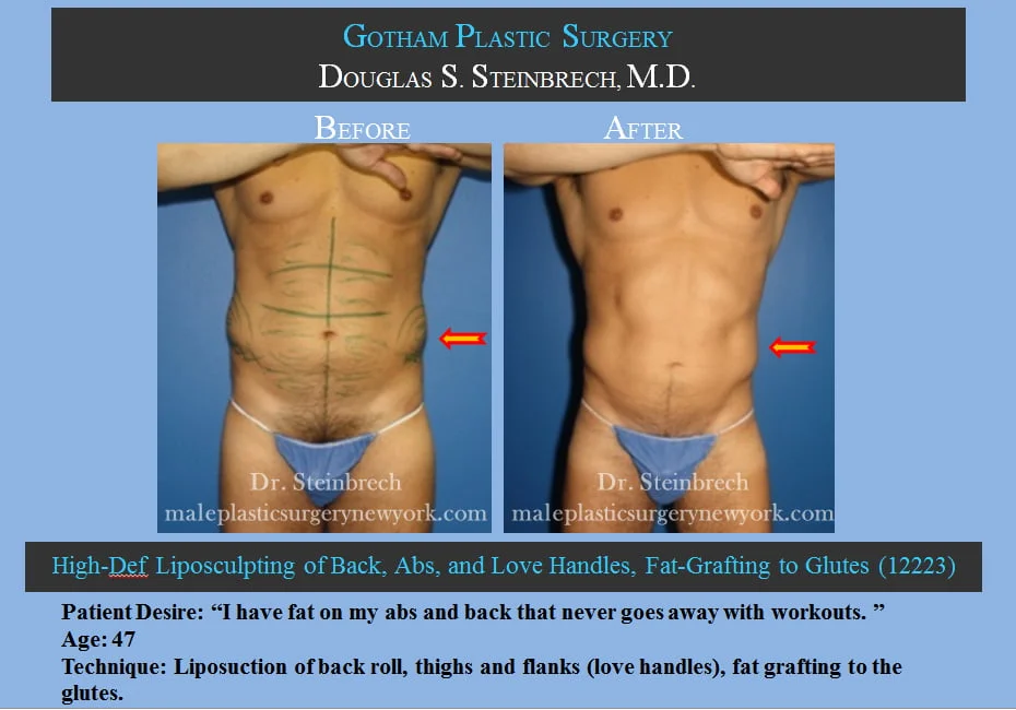 Liposuction - Before & After Photos