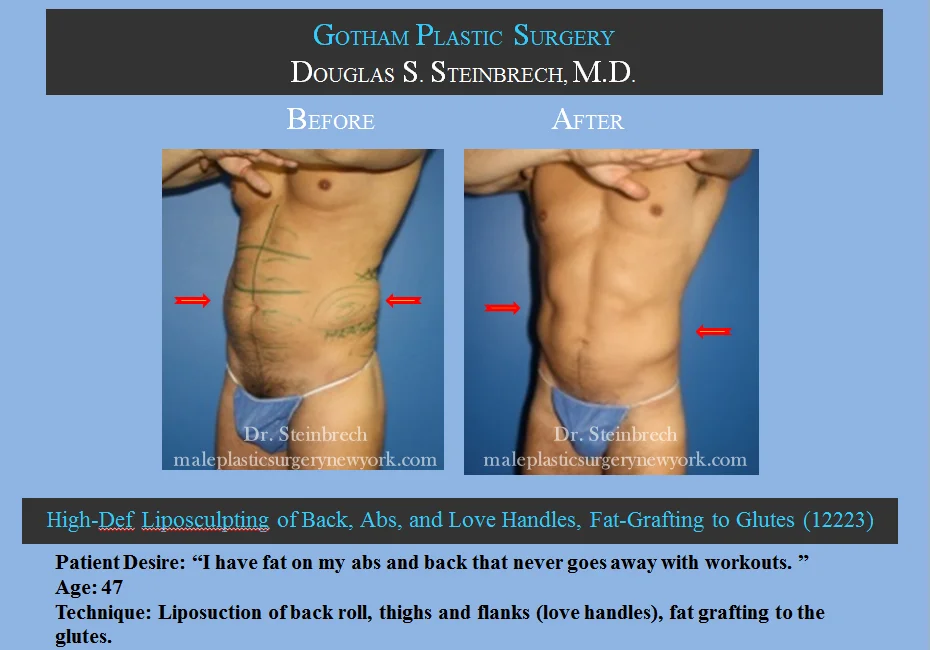 Liposuction - Before & After Photos