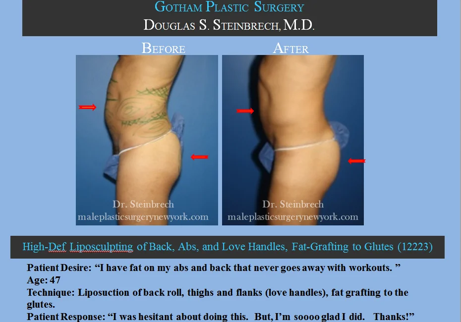 Liposuction - Before & After Photos