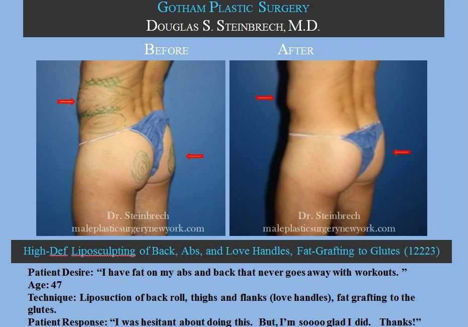 Liposuction - Before & After Photos