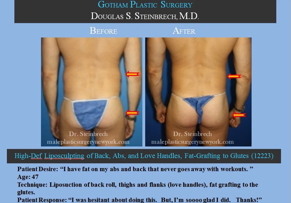 Liposuction - Before & After Photos