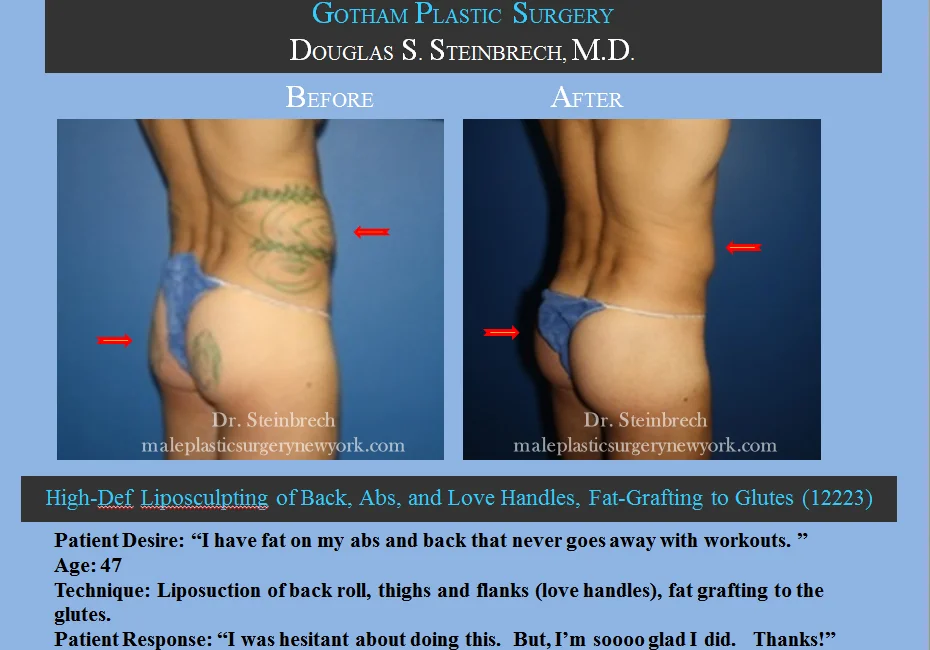 Liposuction - Before & After Photos