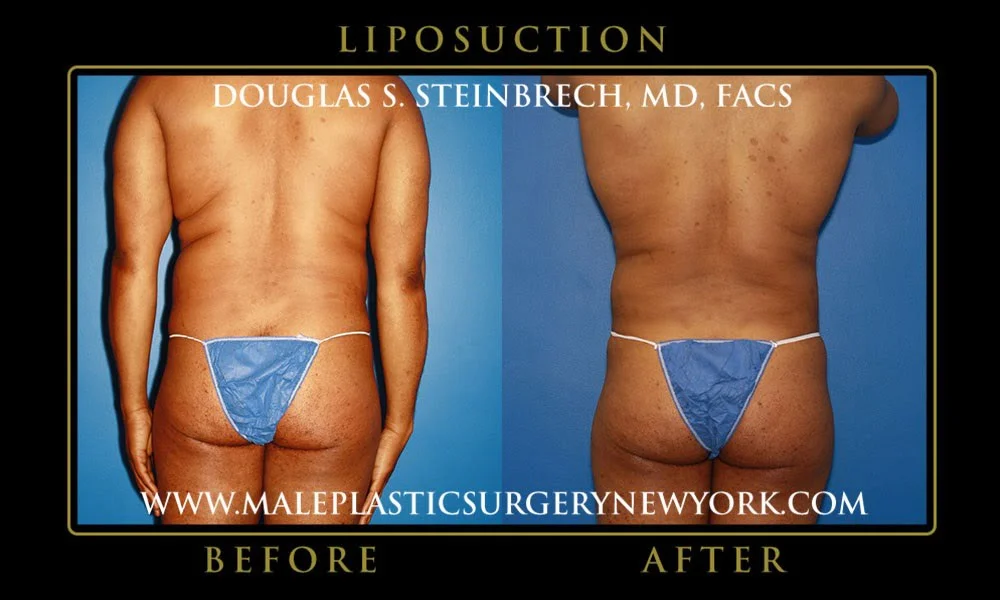 Liposuction - Before & After Photos