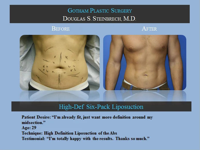 Liposuction - Before & After Photos