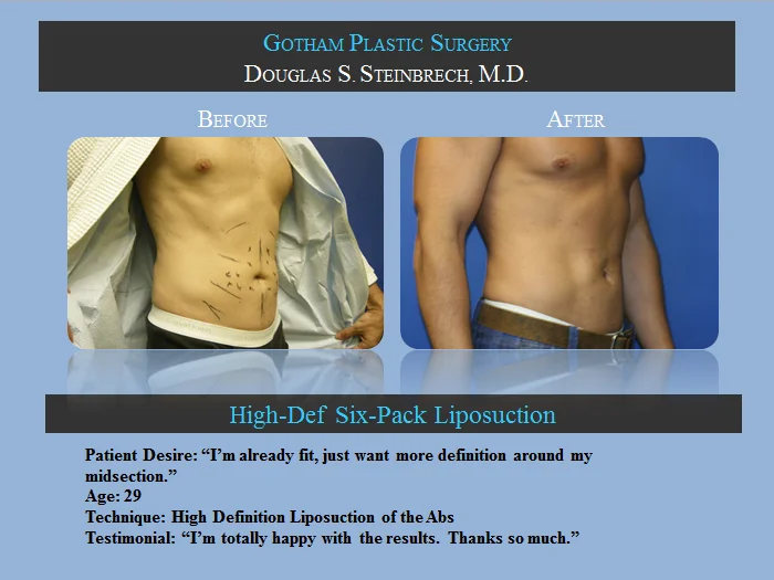 Liposuction - Before & After Photos