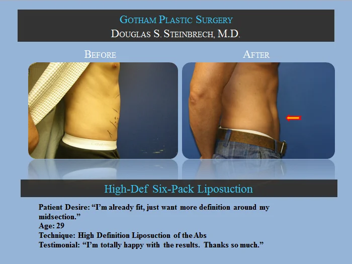 Liposuction - Before & After Photos