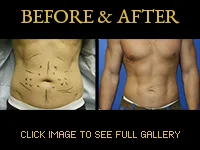 Liposuction - Before & After Photos