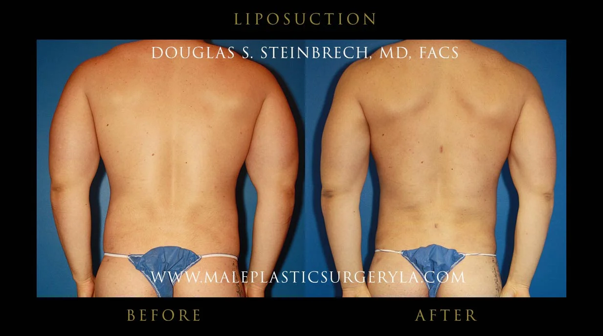 Liposuction - Before & After Photos