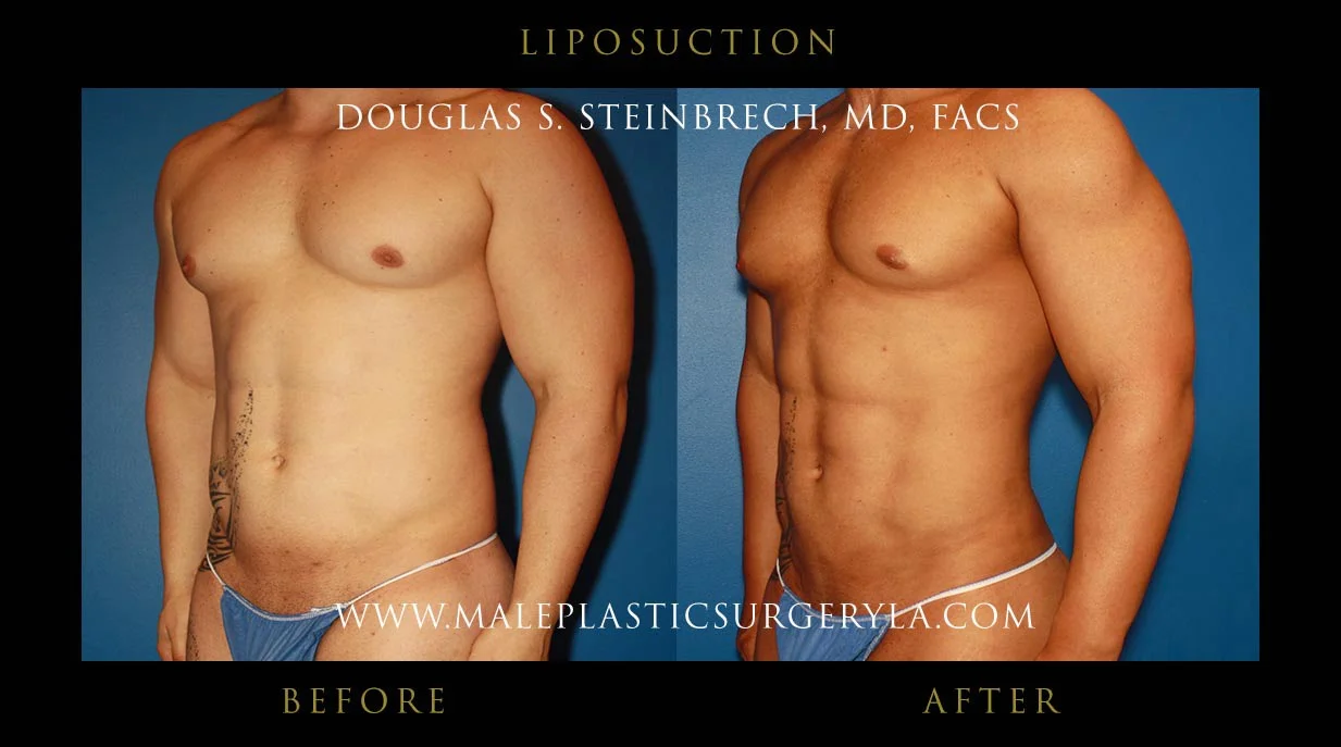 Liposuction - Before & After Photos