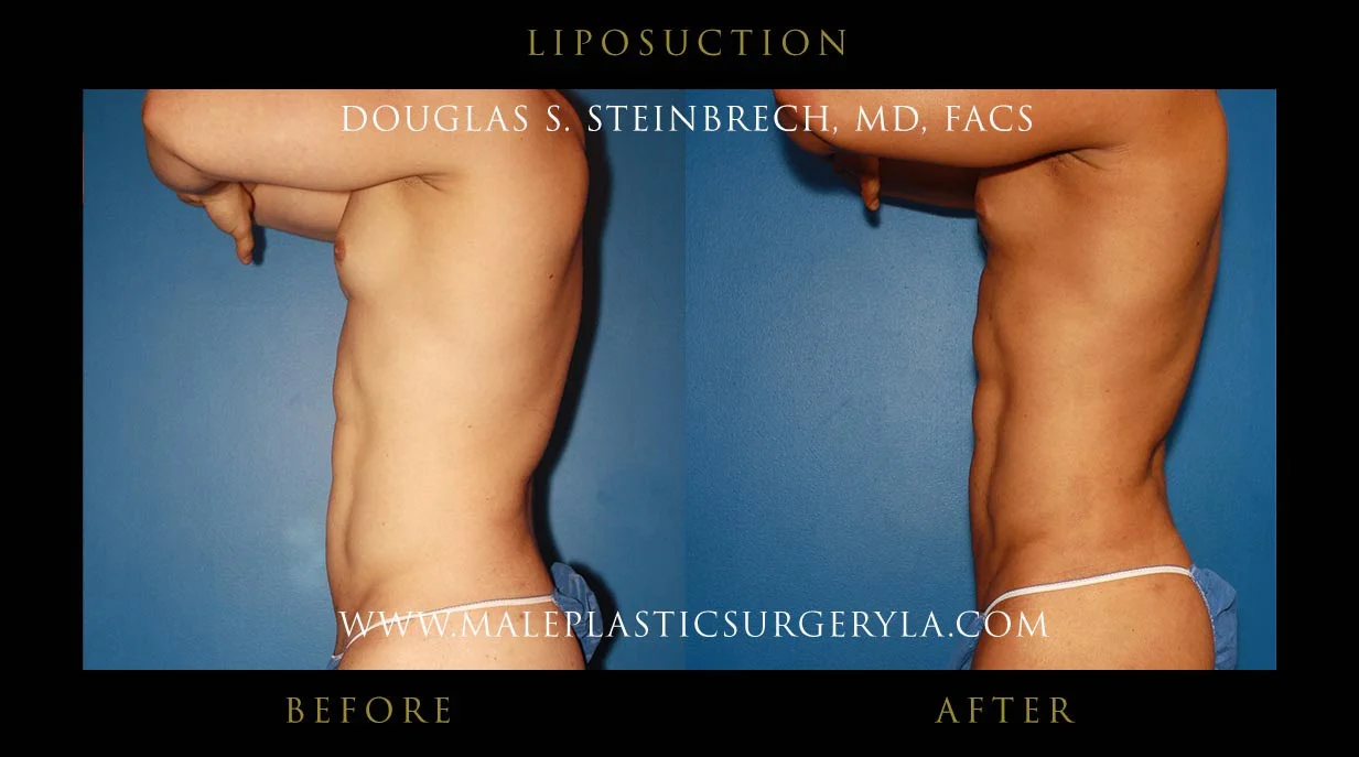 Liposuction - Before & After Photos