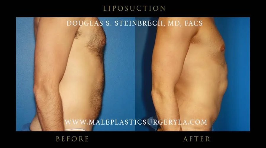 Liposuction - Before & After Photos