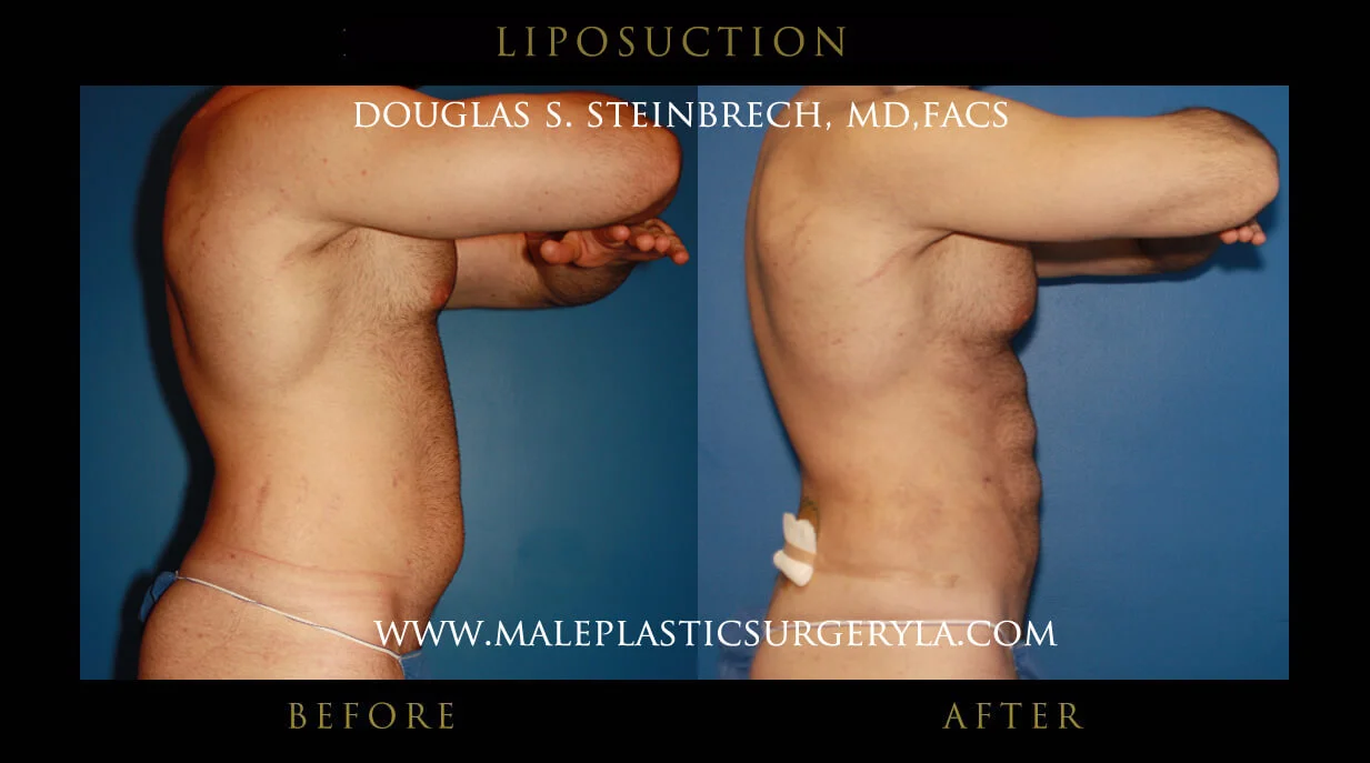 Liposuction - Before & After Photos