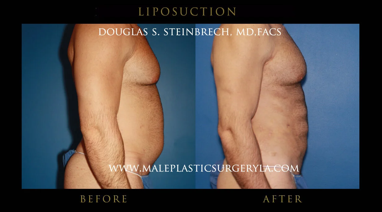 Liposuction - Before & After Photos